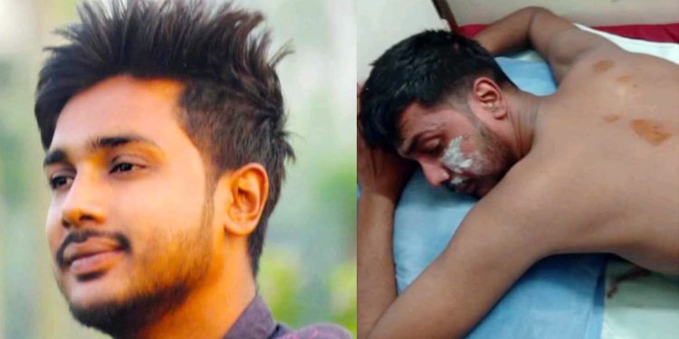 বৈষম্যবিরোধী আন্দোলনে পুলিশের ছোড়া গুলিতে আহত মিলন পায়নি কোন চিকিৎসা সহায়তা-নাম নেই আহতদের তালিকায়